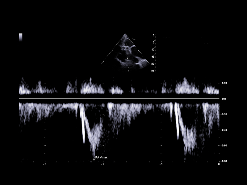 Equine clinical image -pulmonary artery flow velocity assessment with PW