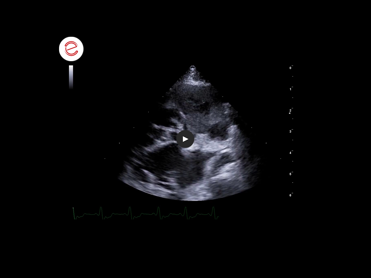 Right atrial Hemangiosarcoma 1