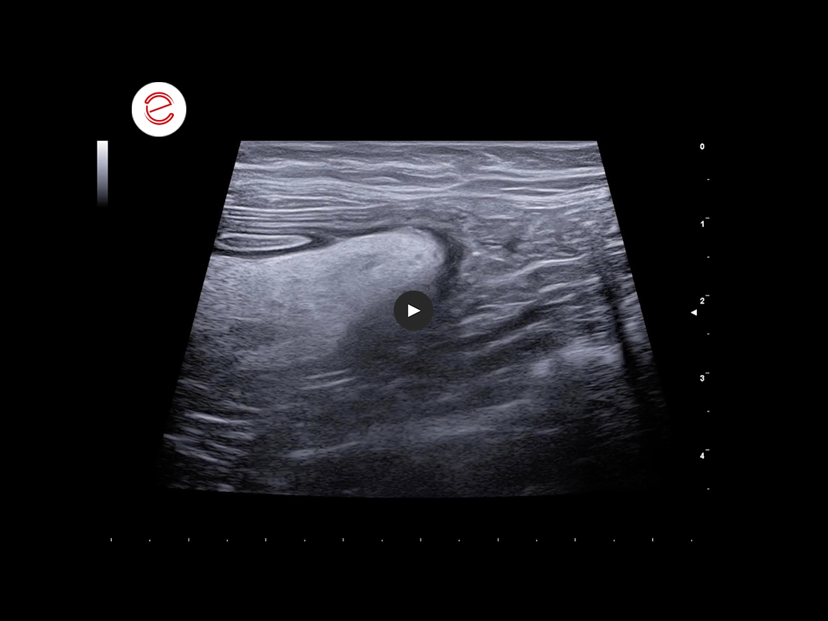 Ileocolic intestinal intussusception 5