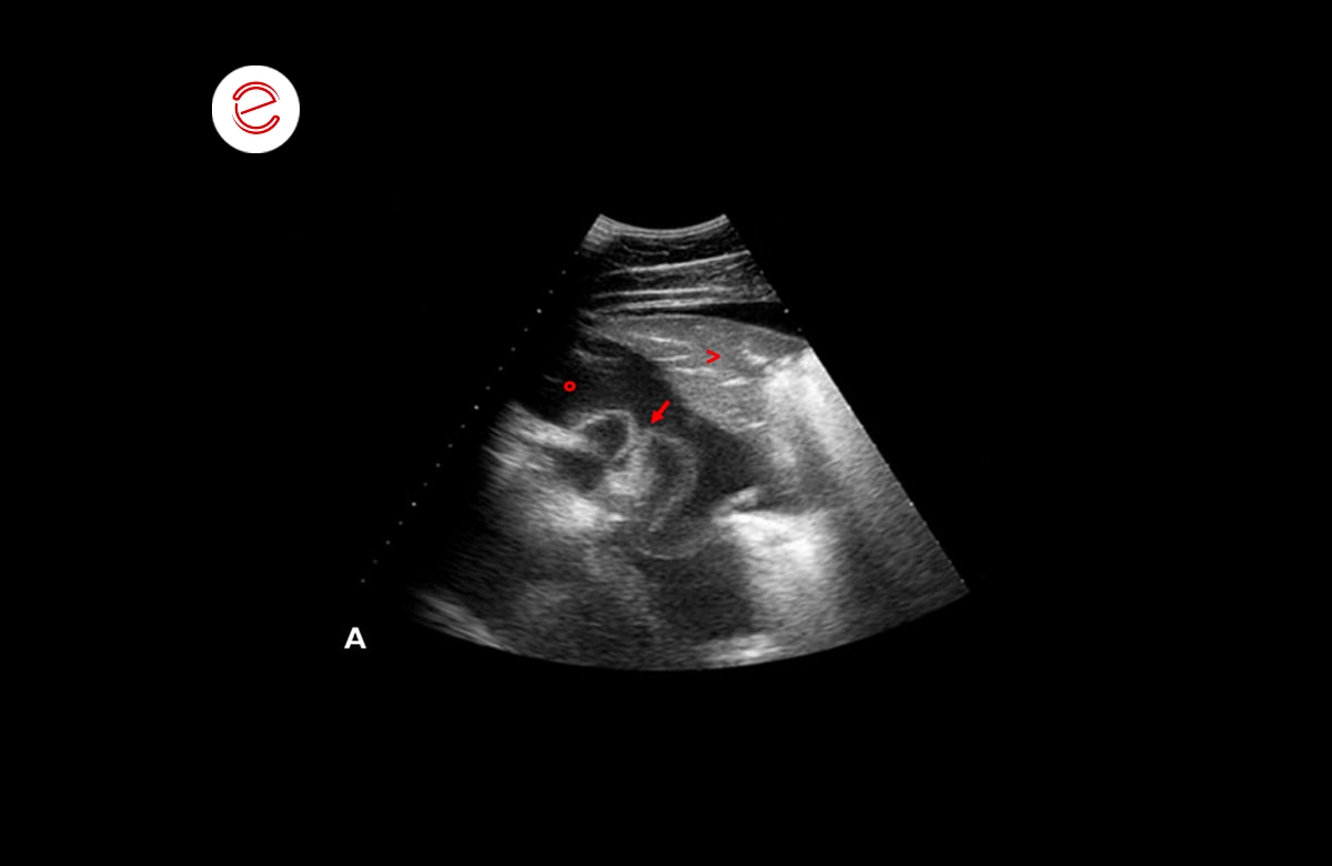 Ultrasound examination of the left side of the thorax revealed a moderate amount of anechoic fluid (o) in the pleural cavity 