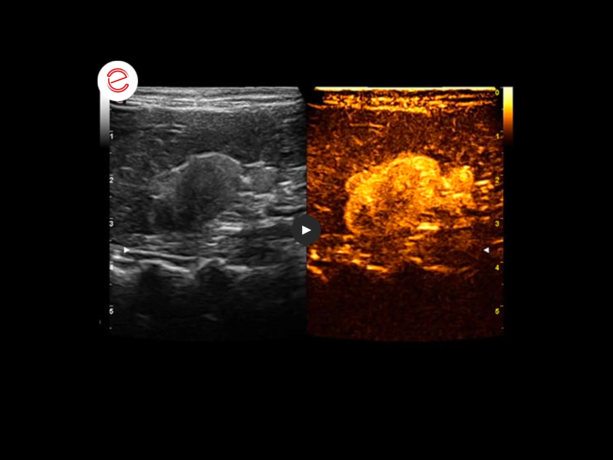 Adrenal adenoma 5