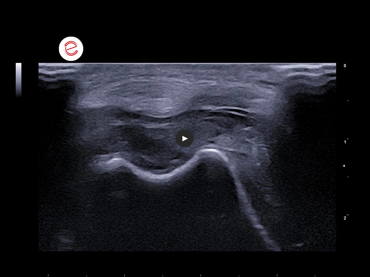 Synovial Sarcoma 3