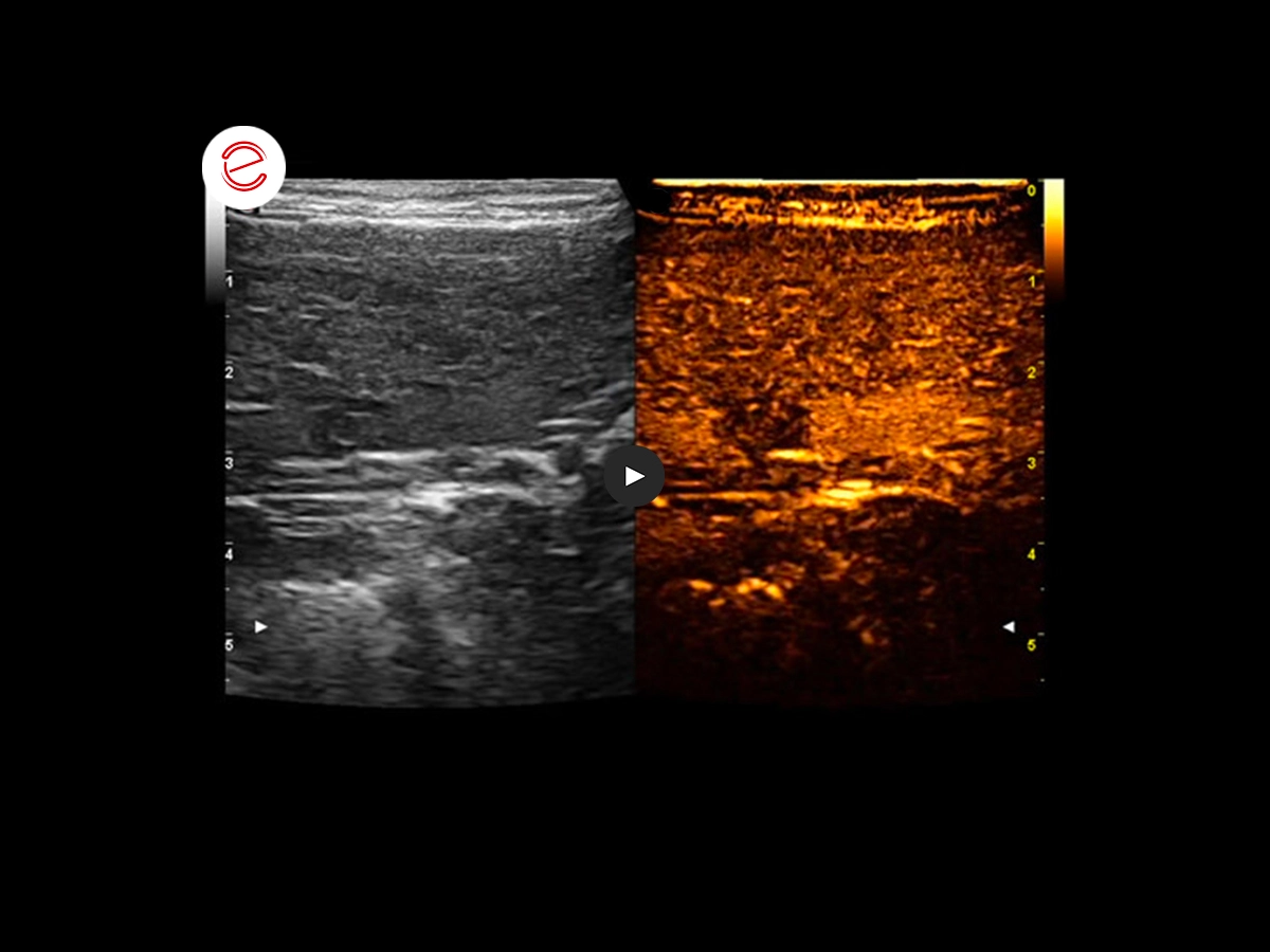 Adrenal adenoma 4