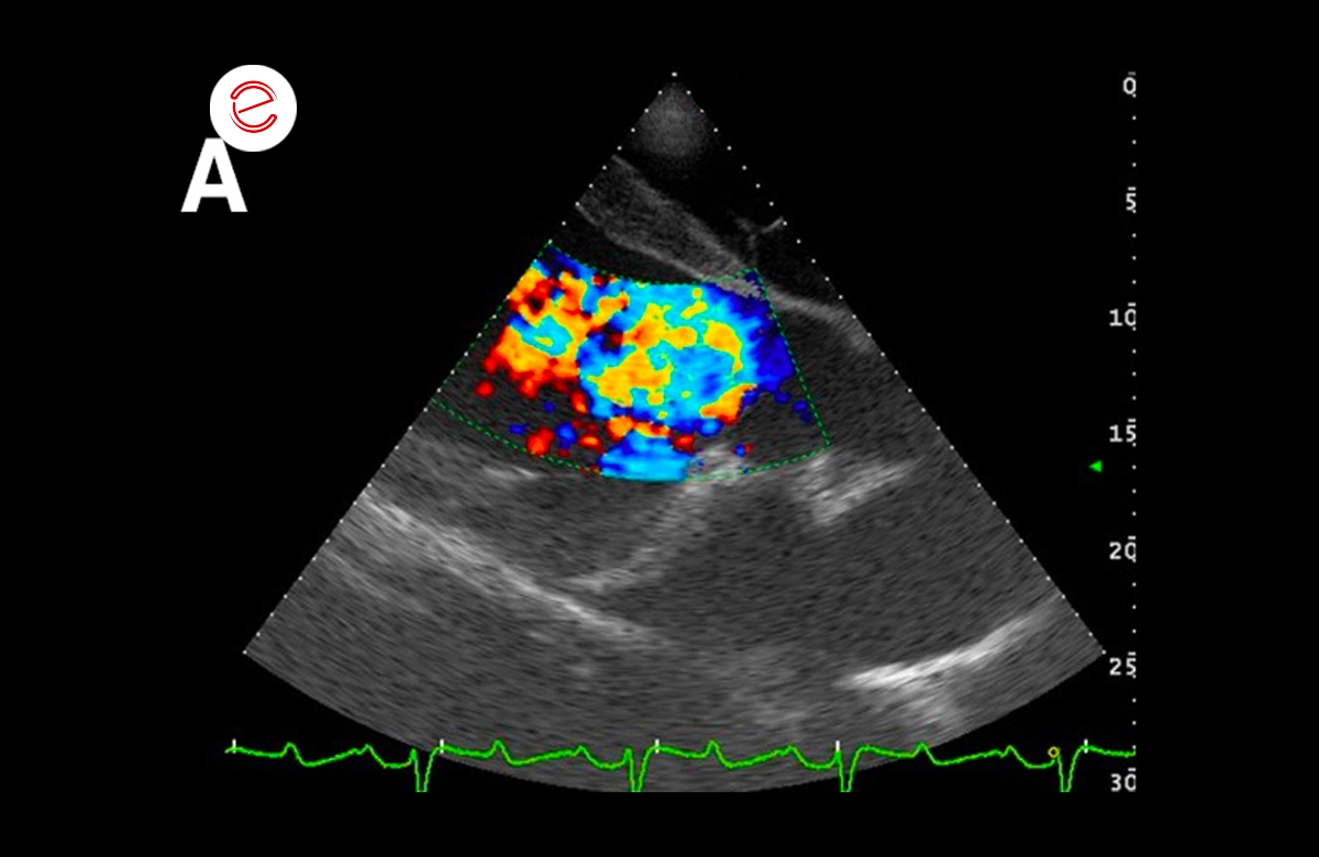 Severe aortic regurgitation jet