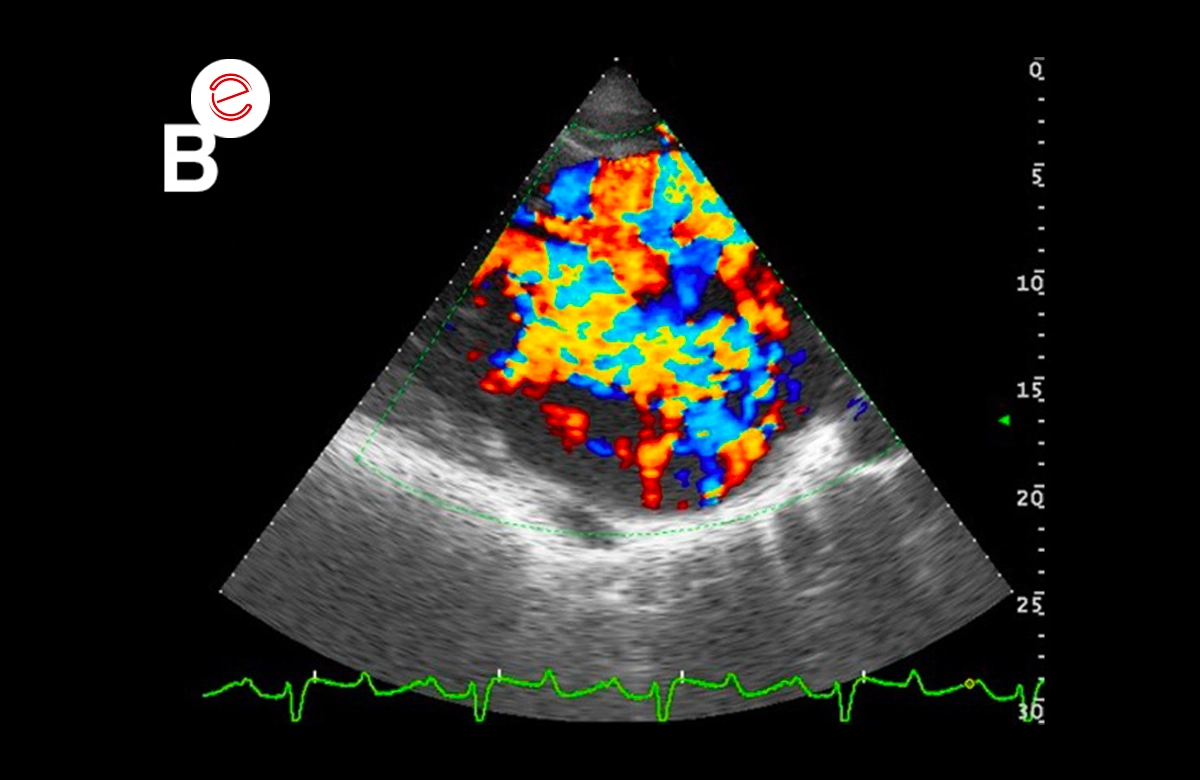 Severe mitral regurgitation jet