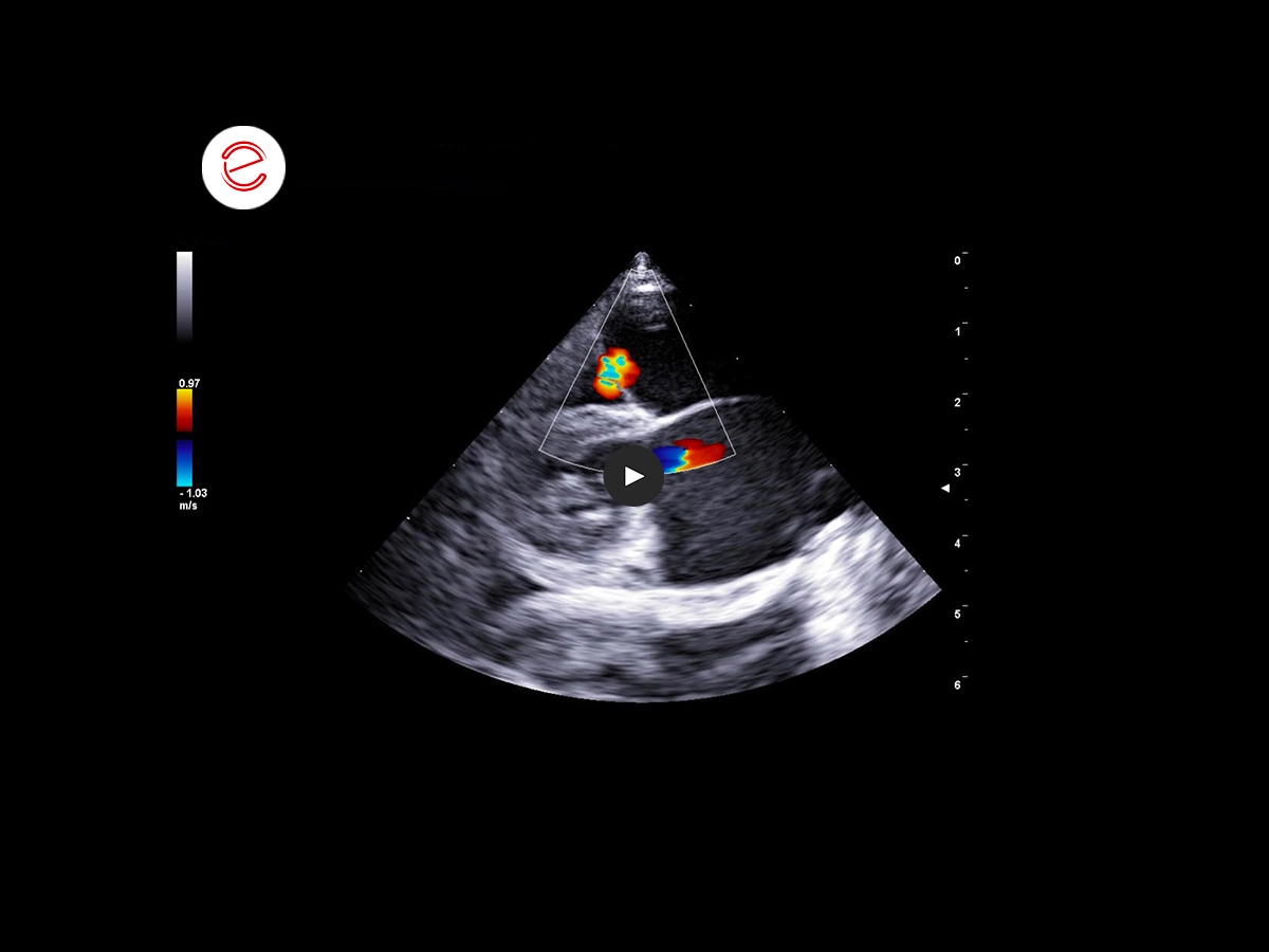 Restrictive cardiomyopathy 3