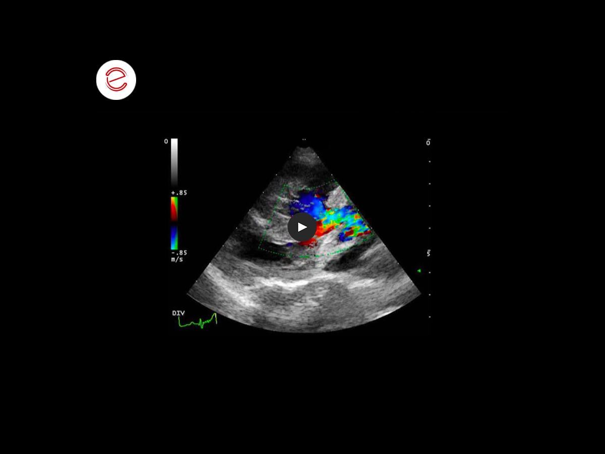 Tetralogy of fallot 4