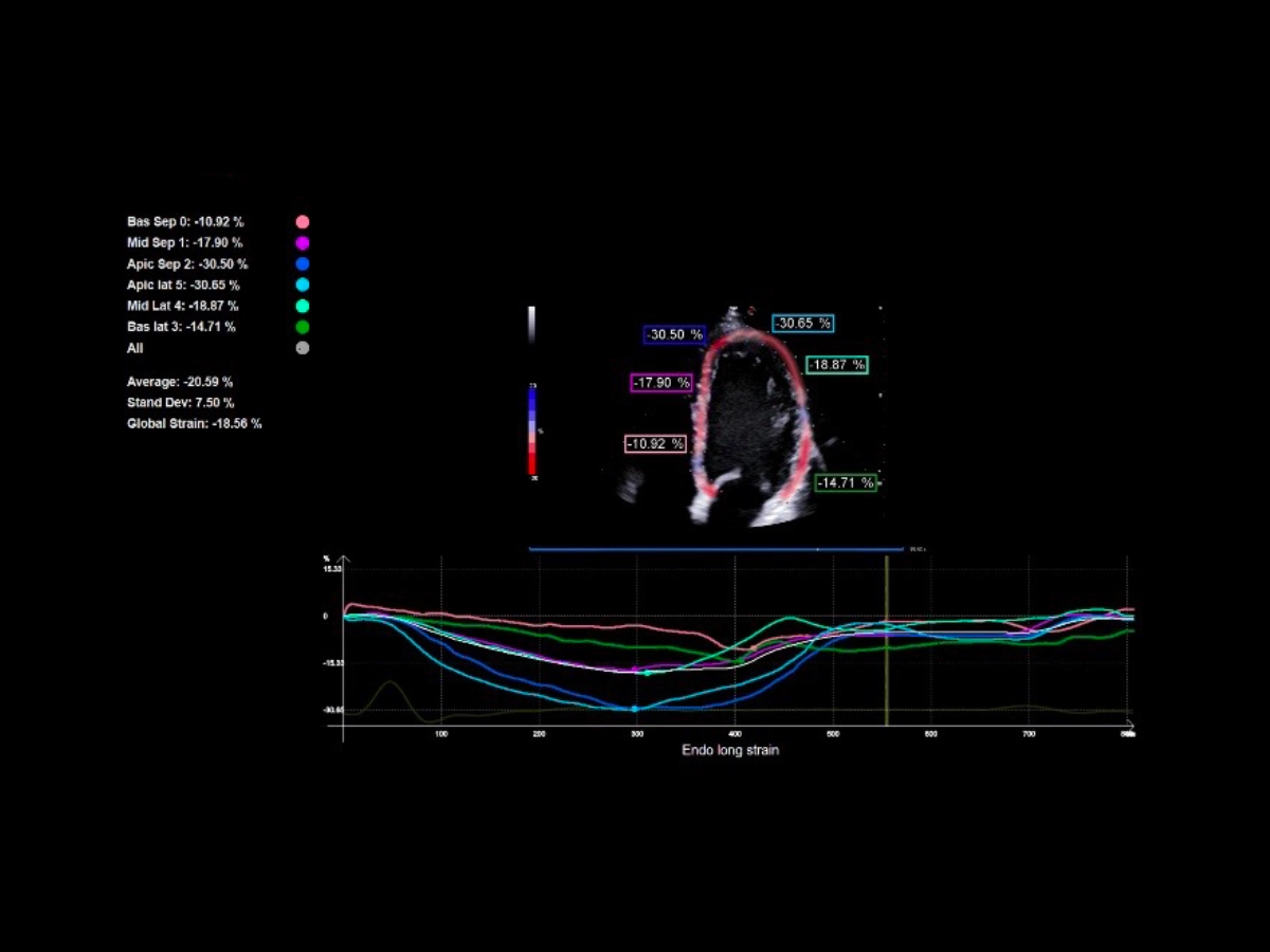 Echocardiographic Strain, XStrain™