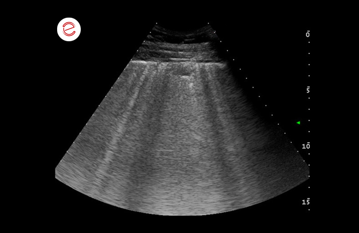 Numerous comet tail artefacts widespread on both the right and left side that are suggestive of pulmonary edema.