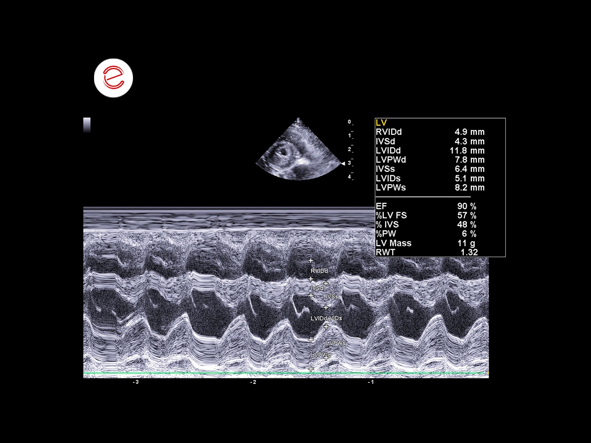 Restrictive cardiomyopathy 8