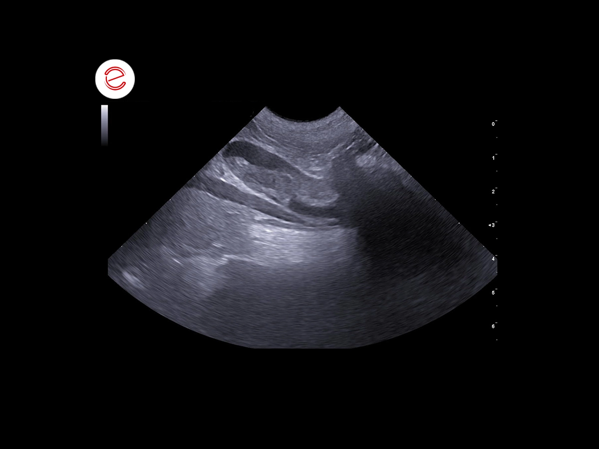 Fusiform endoluminal hyperechoic structure in the aortic lumen between the renal artery and the aortic trifurcation