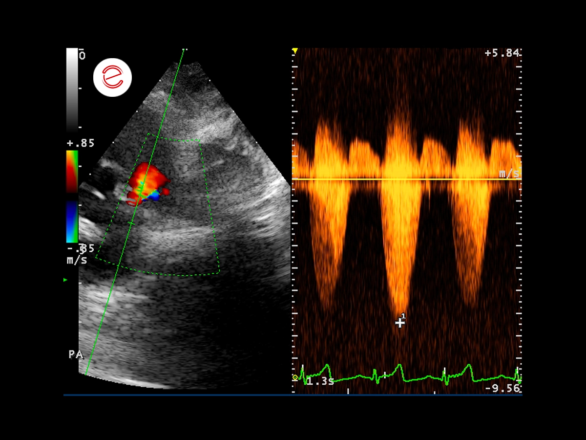 Right parasternal window, continuous wave spectral Doppler