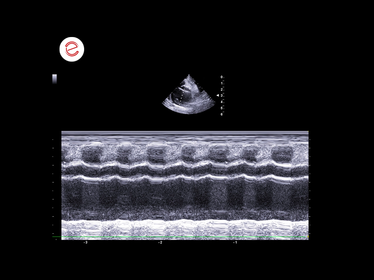 Restrictive cardiomyopathy 2