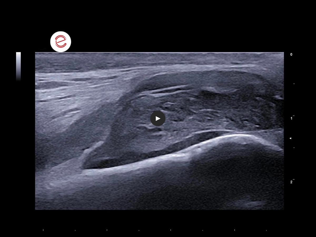 Synovial Sarcoma 4