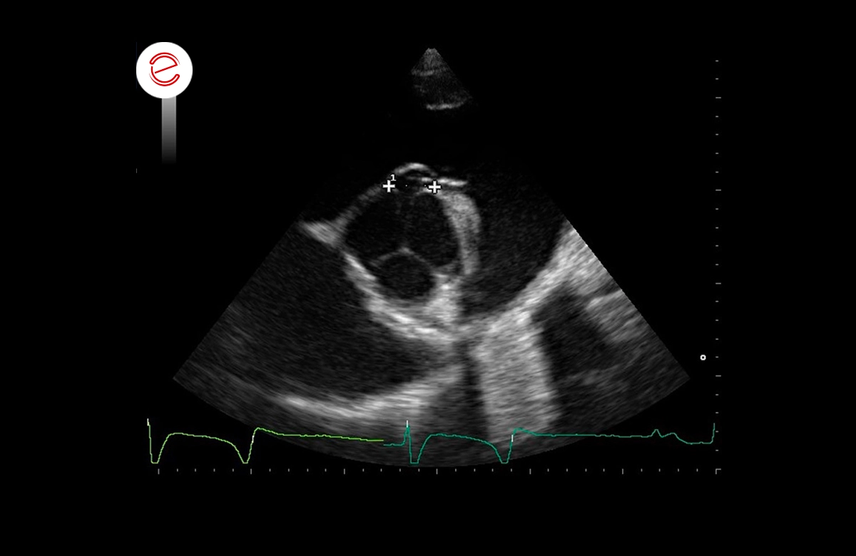 Right parasternal short axis view at the level of the aortic valve