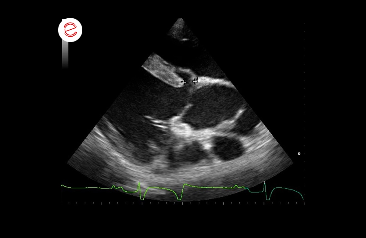 Right parasternal long axis view of the left ventricular outflow tract and aorta