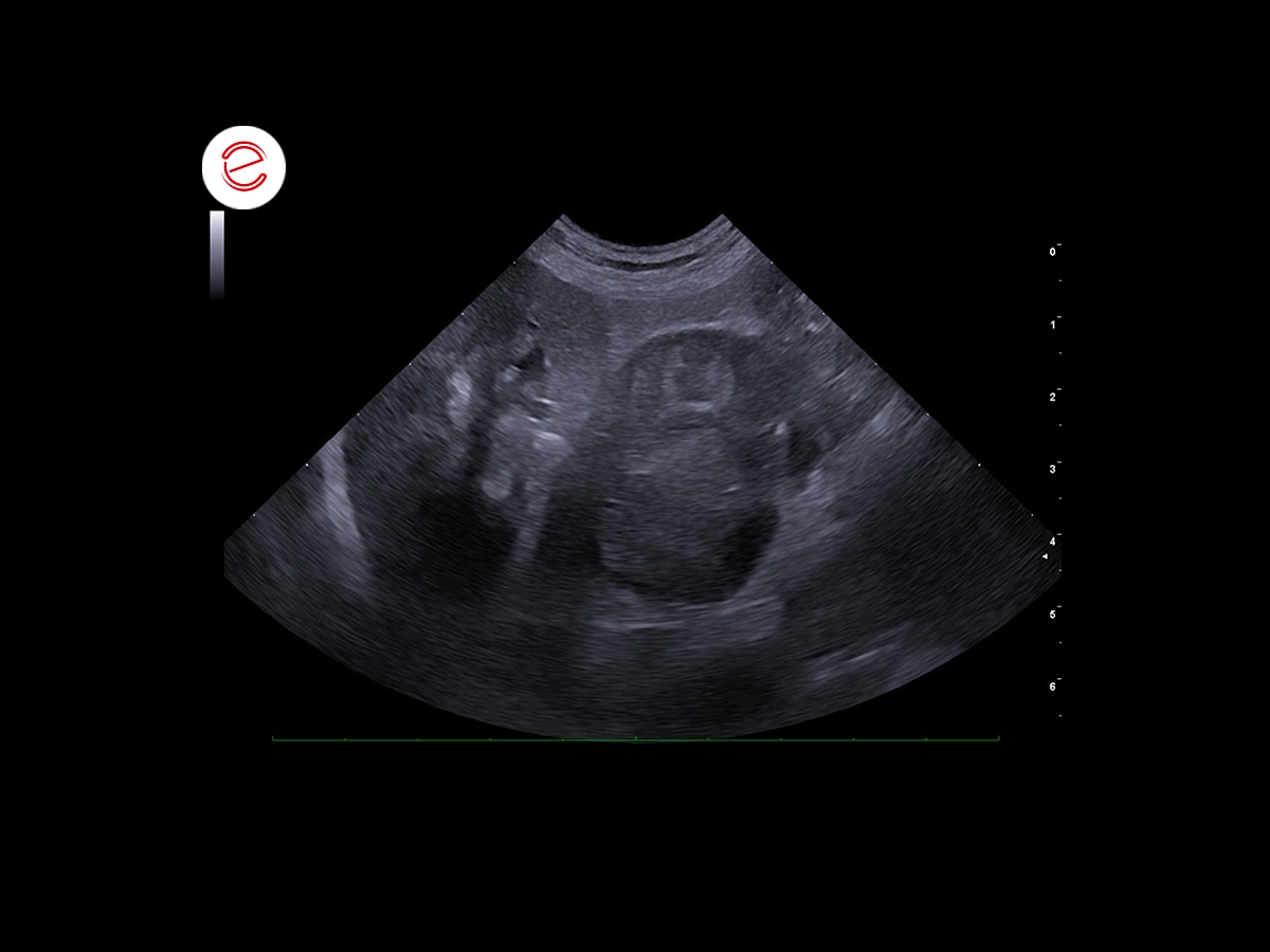 The right adrenal gland is markedly increased in thickness (3.3 cm) due to the presence of a heterogeneous mass which destructures its morphology