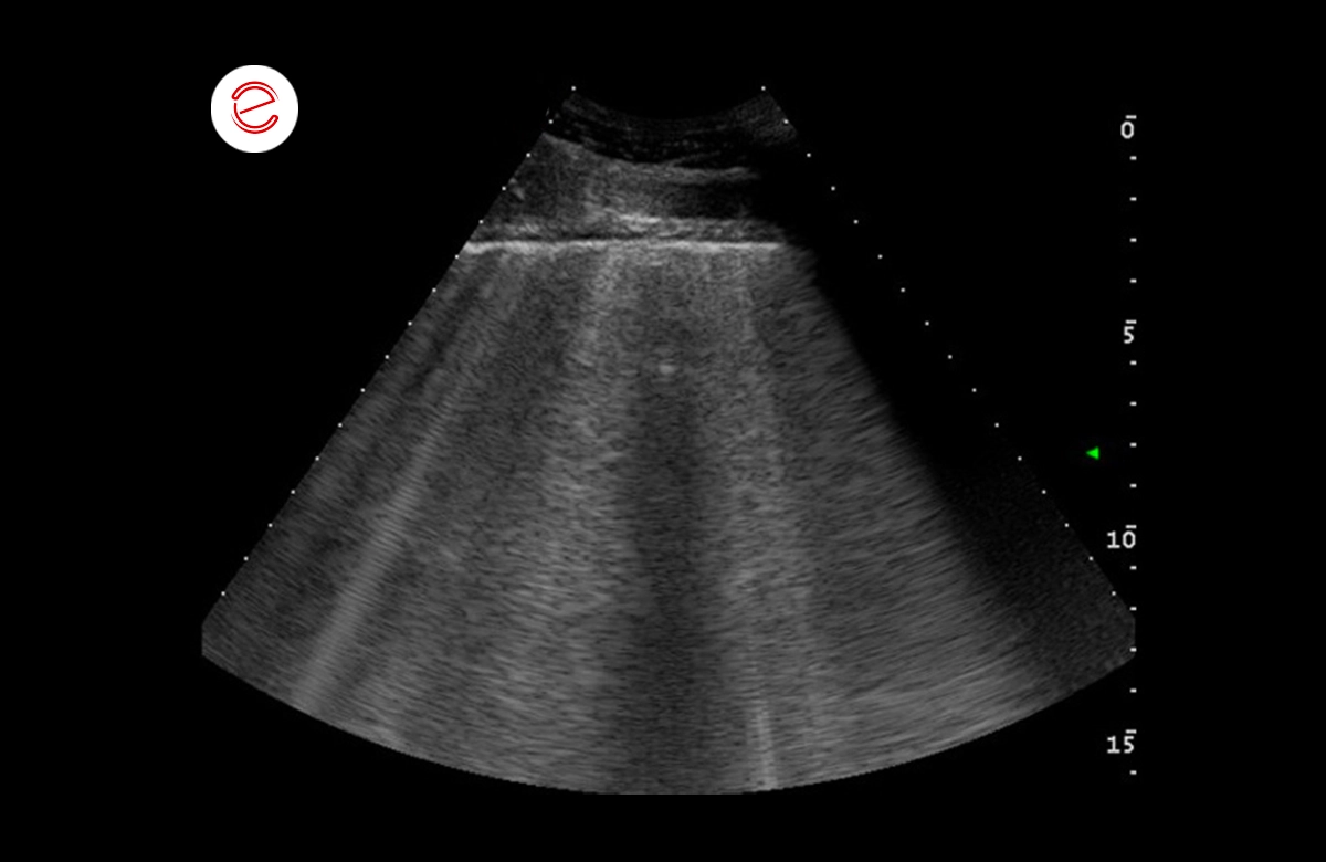 Numerous comet tail artefacts widespread on both the right and left side that are suggestive of pulmonary edema.