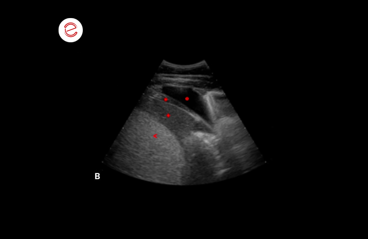 Diaphragm, liver and spleen