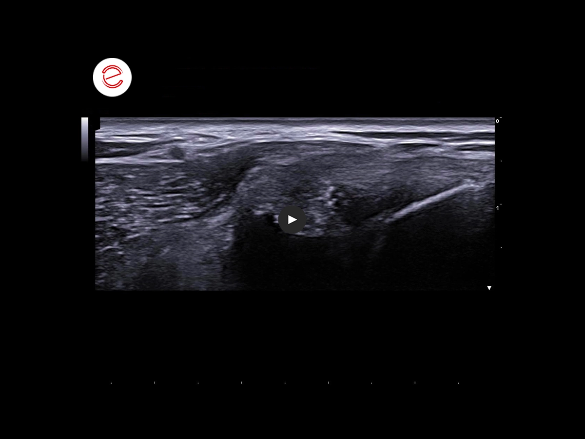 Brachial biceps rupture 3