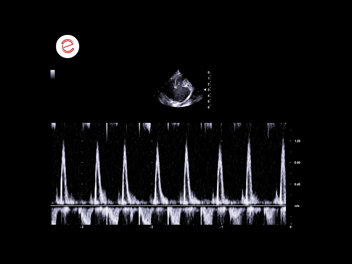 Left parasternal, Apical 4 chamber Trans-mitral flow showing just the E-wave, a sign of early ventricular filling, at high velocity.