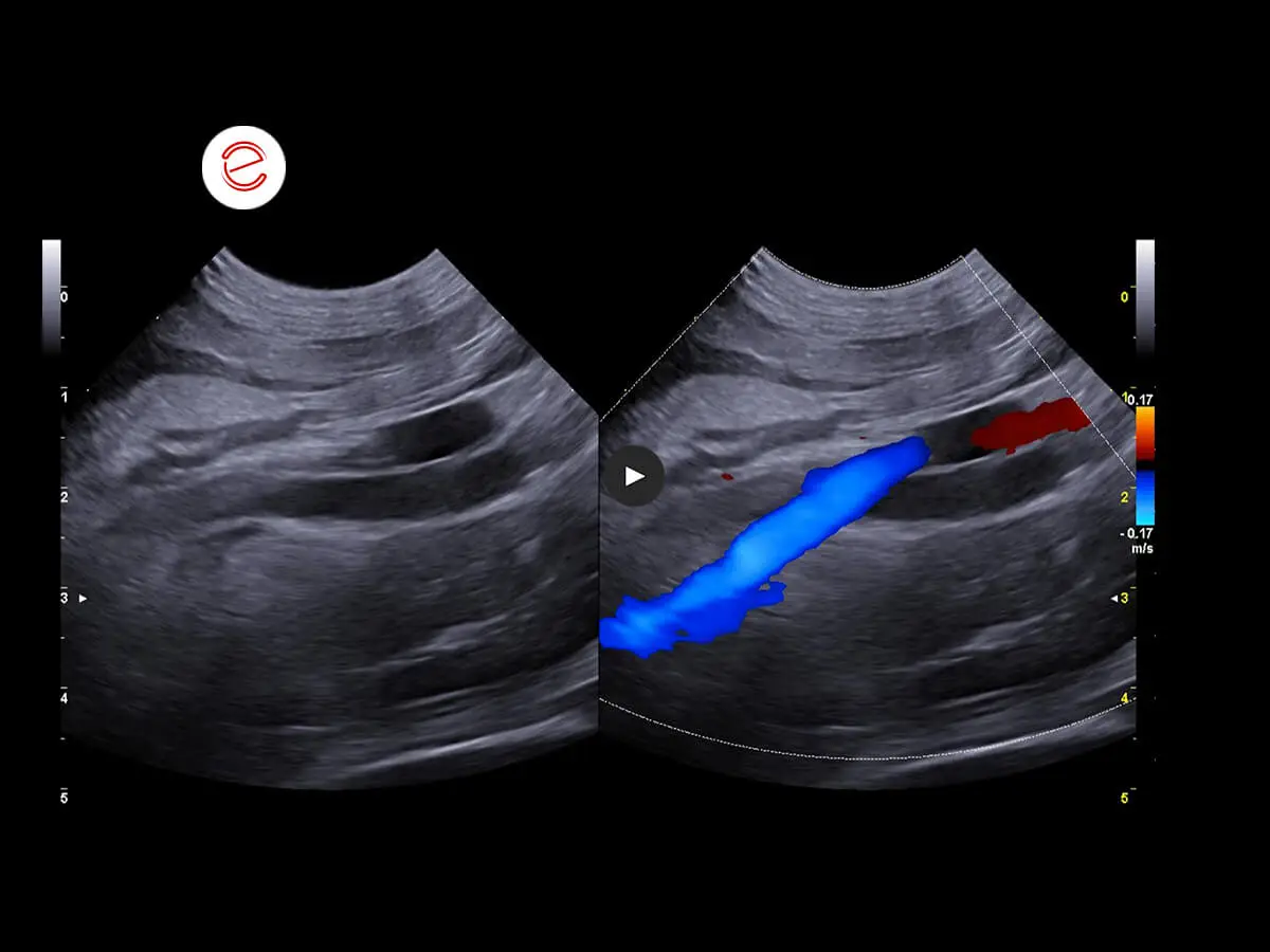 Course of the right ureter in relation to the vessels.