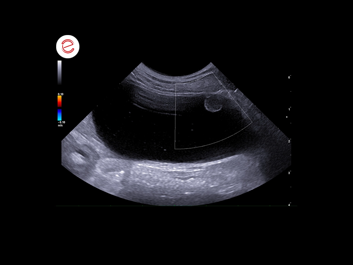 The bladder has punctiform hyperechoic contents in suspension