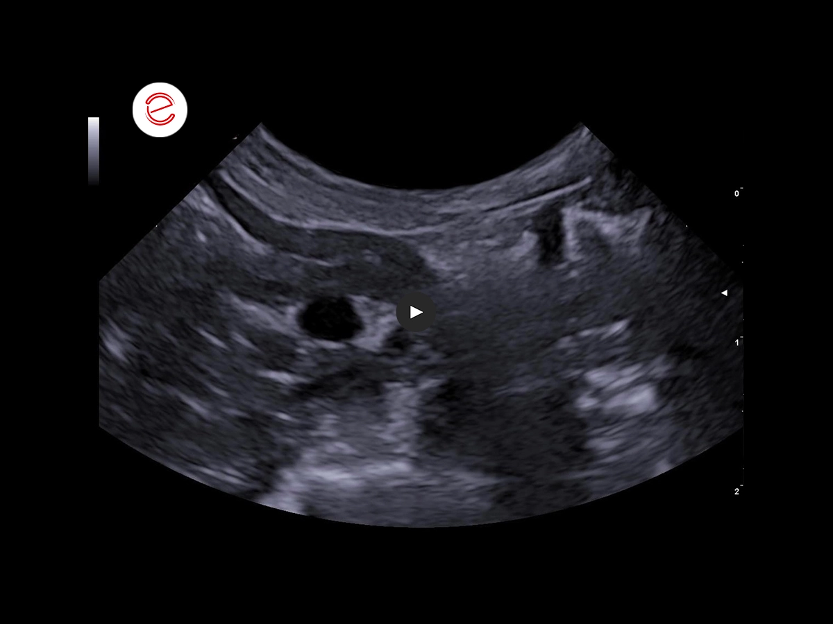 Gastric and intestinal ulcers 2