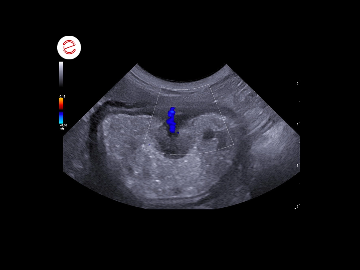 Stomach with the presence of fluid and gaseous echogenic contents, probably food.