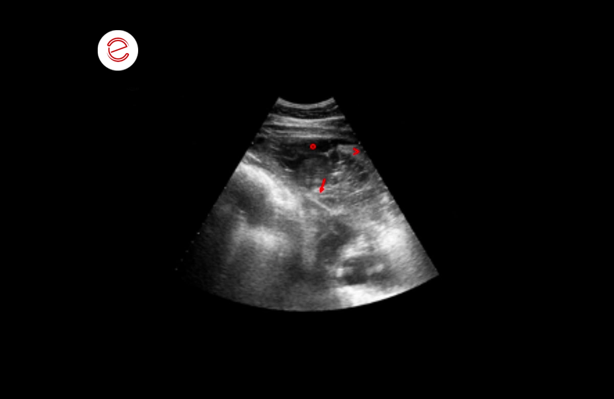 Areas of consolidated lung and a moderate amount of pleural fluid in which the presence of fibrin