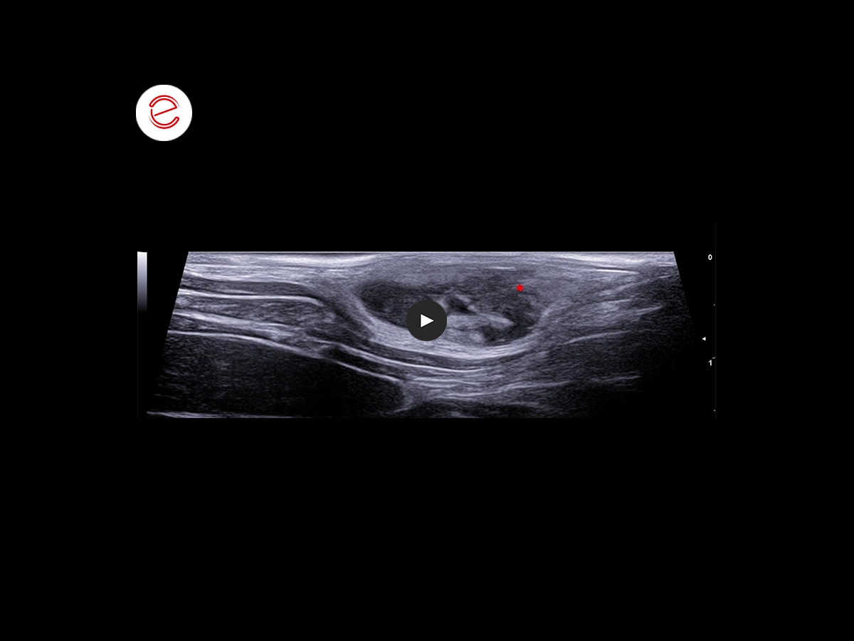 Corneal ulcer 2