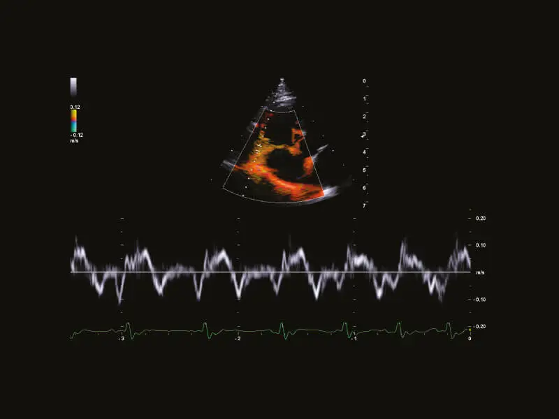 MyLab™Omega eXP VET - Dog - TDI analysis with TVM