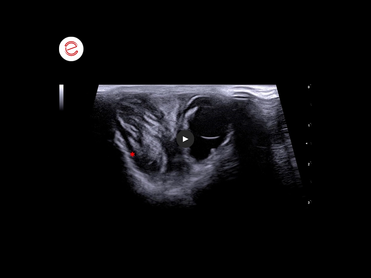 Corneal ulcer 1