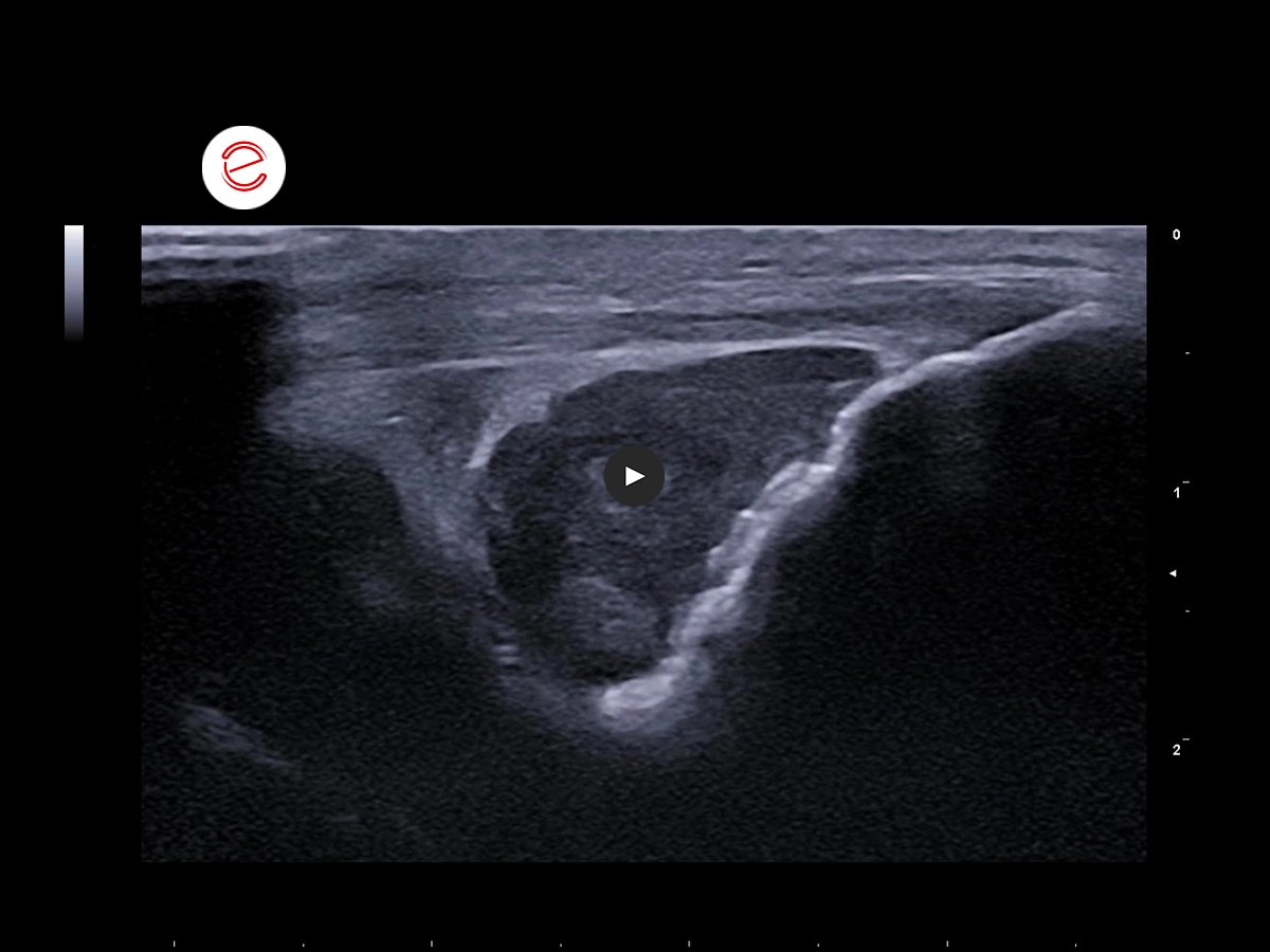 Synovial Sarcoma 1