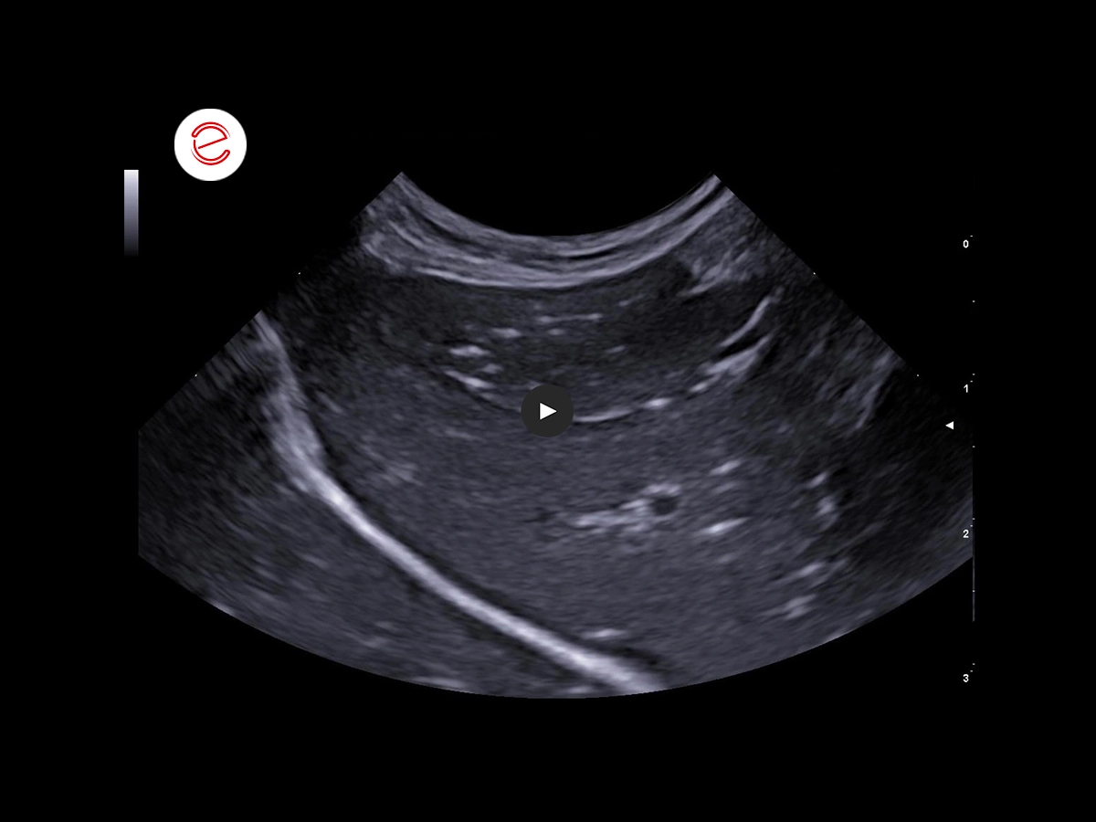 Gastric and intestinal ulcers 1