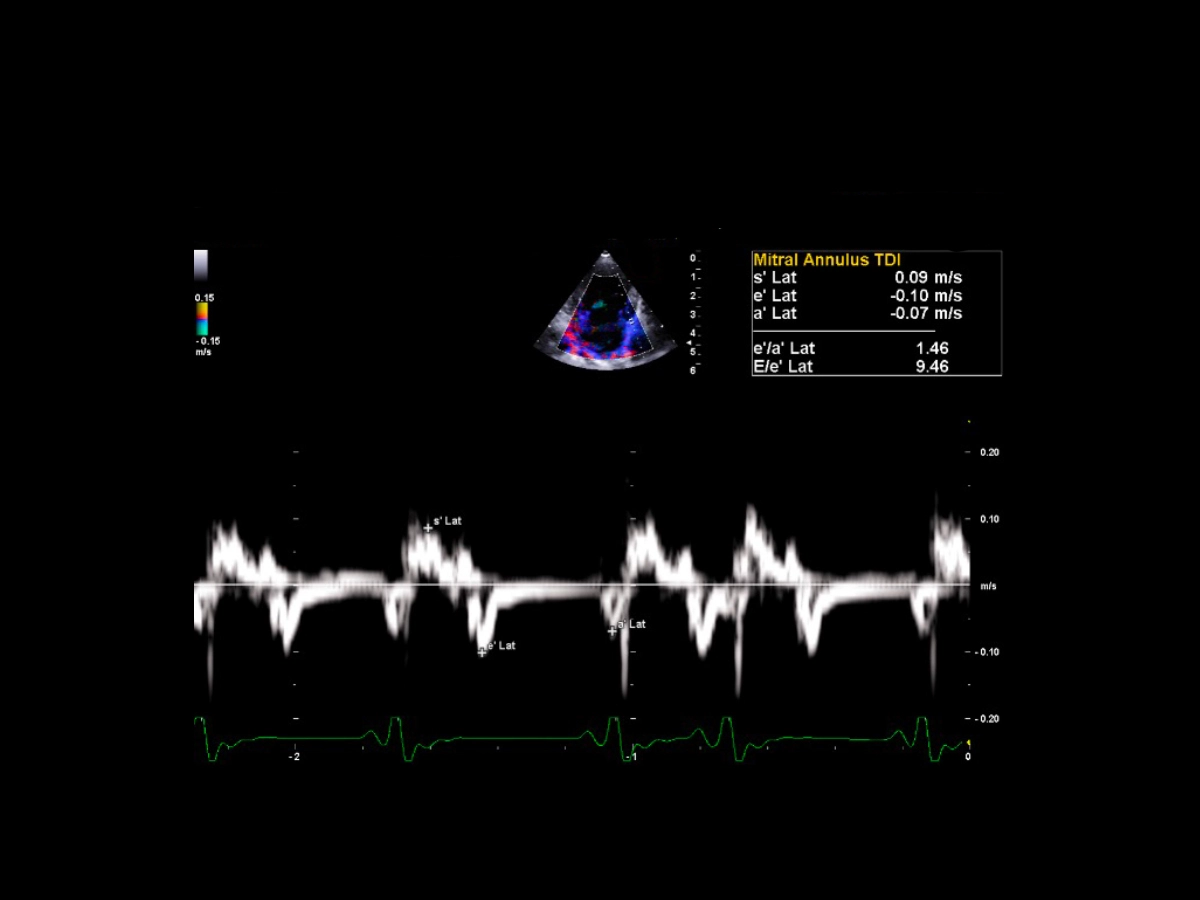 Wall Motion Analysis