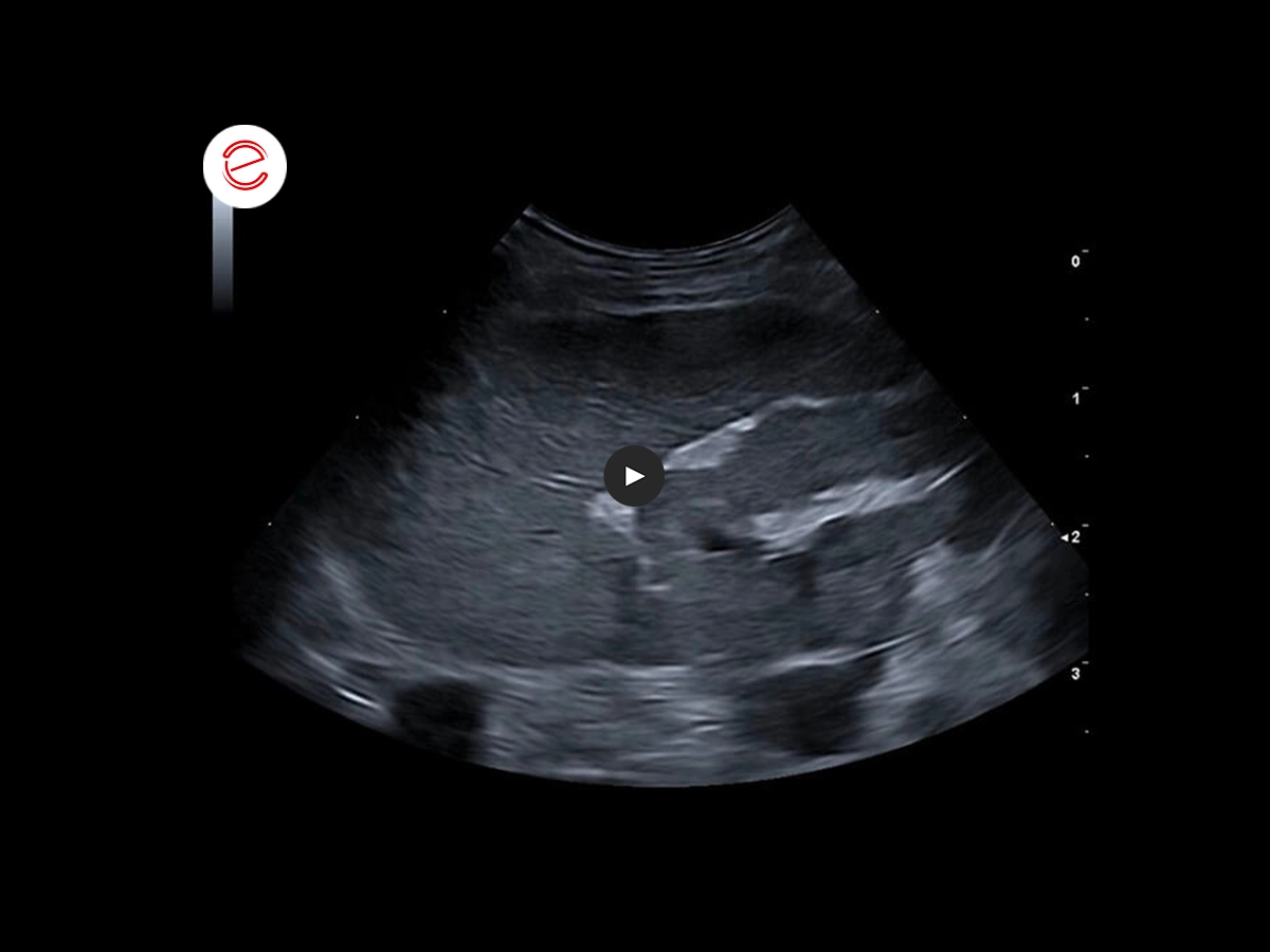 Ultrasound examination of the liver