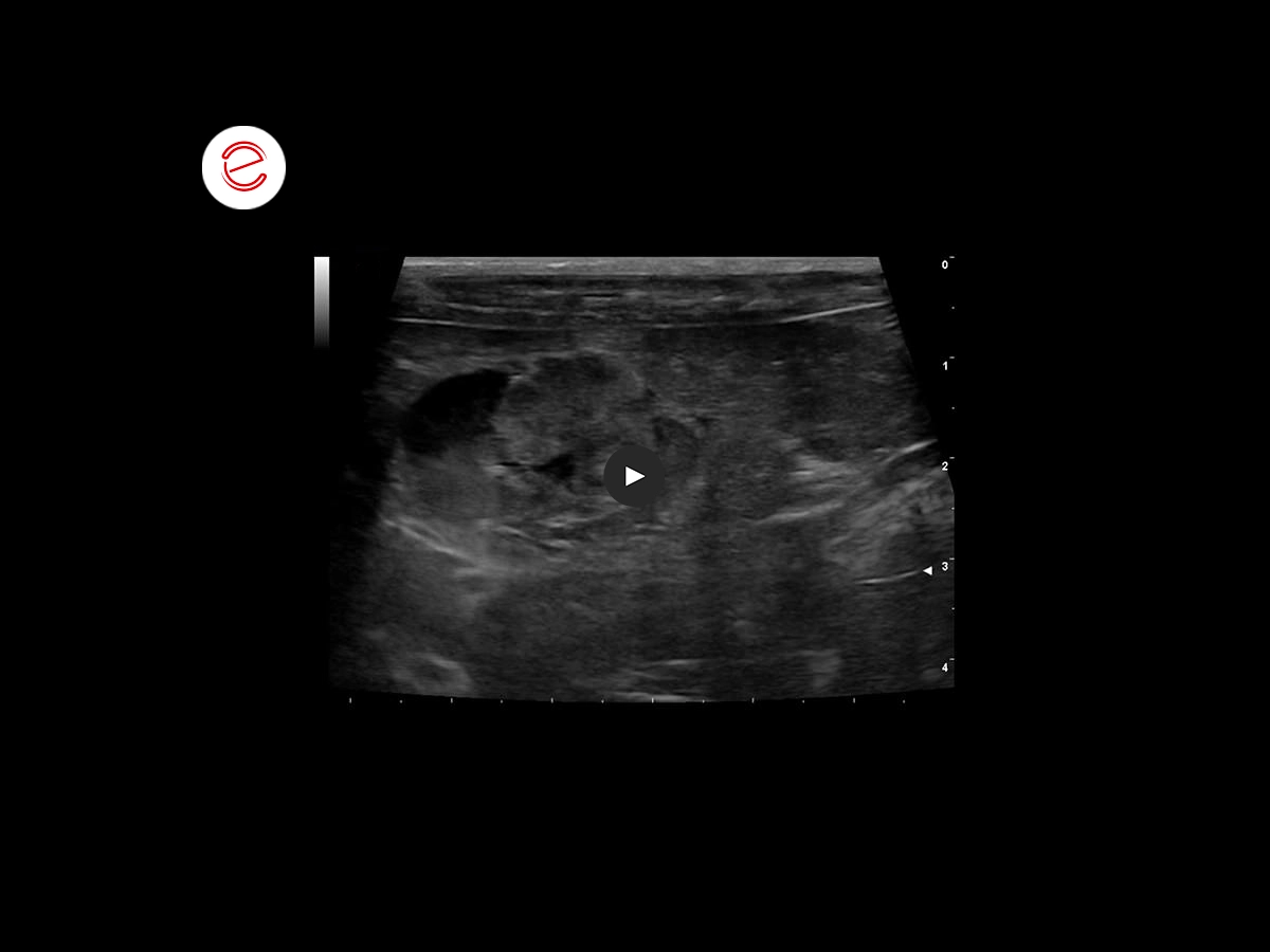 Gallbladder neuroendocrine neoplasm 1