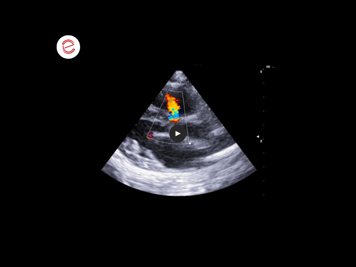 Ventricular septum defect 1