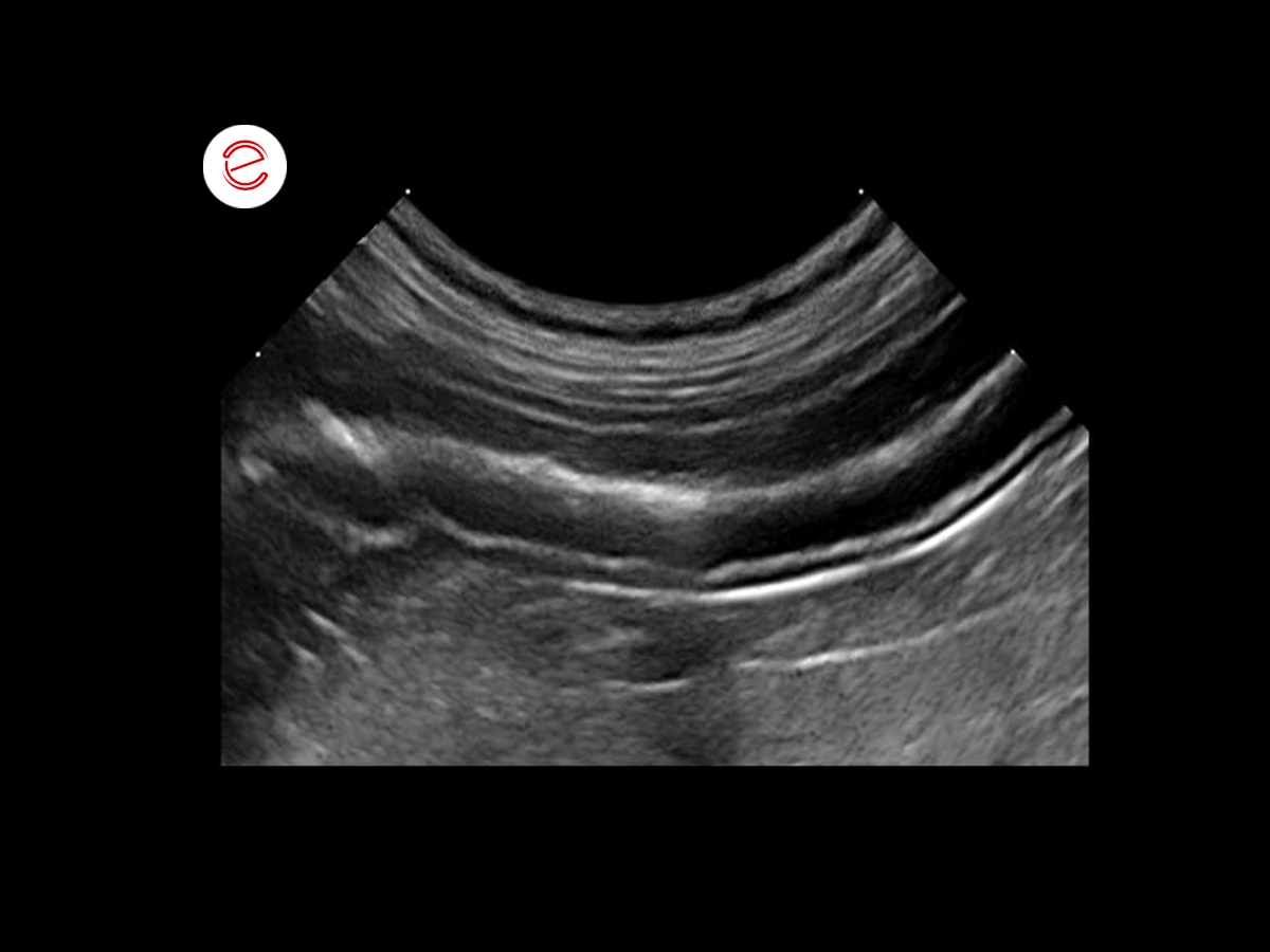 Physiological stratigraphy of a jejunal loop