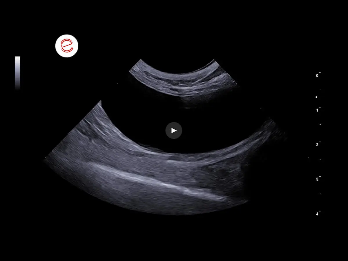 Bladder with walls in the normal range of thickness and stratigraphy; normal anechoic endoluminal content.