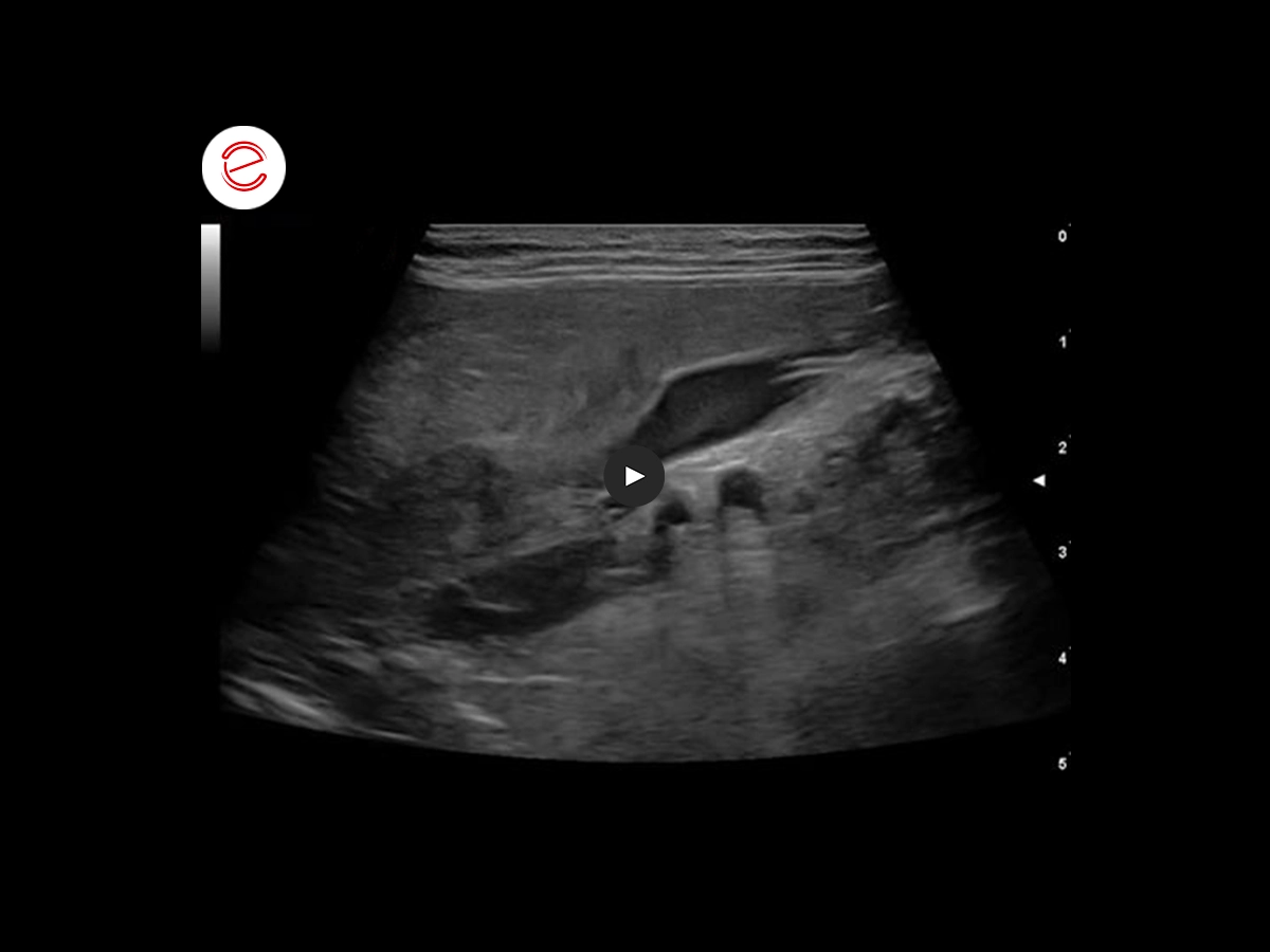 Adrenal adenoma 1