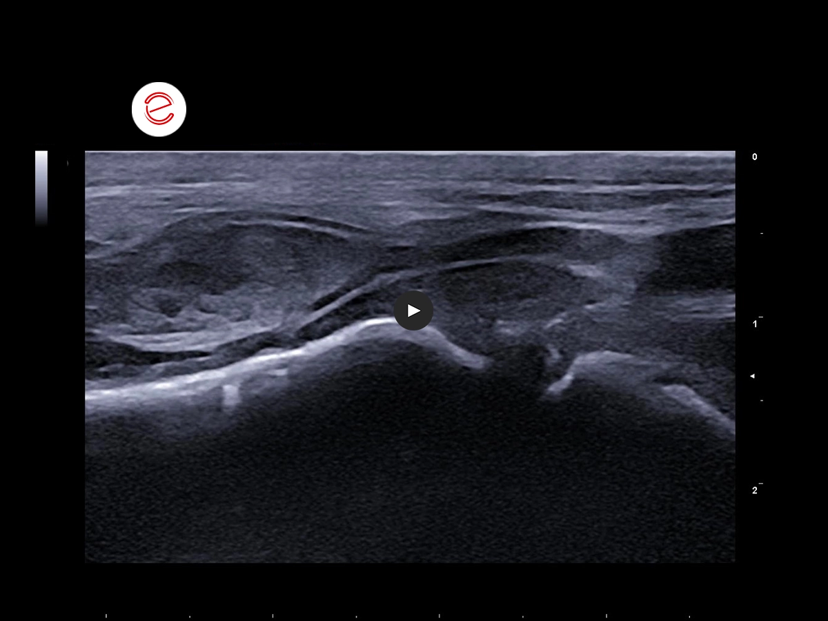 Synovial Sarcoma 2