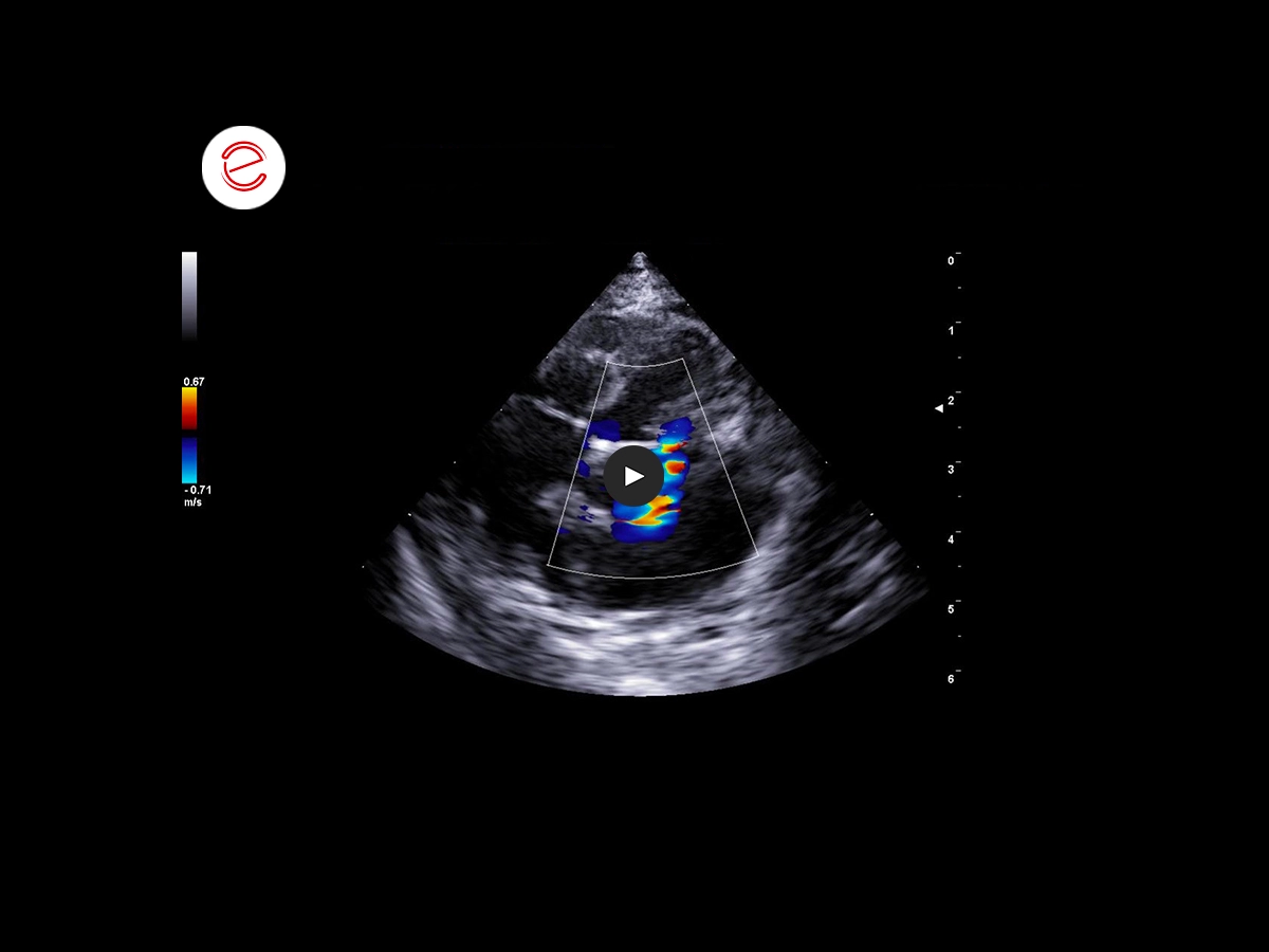 Restrictive cardiomyopathy 6