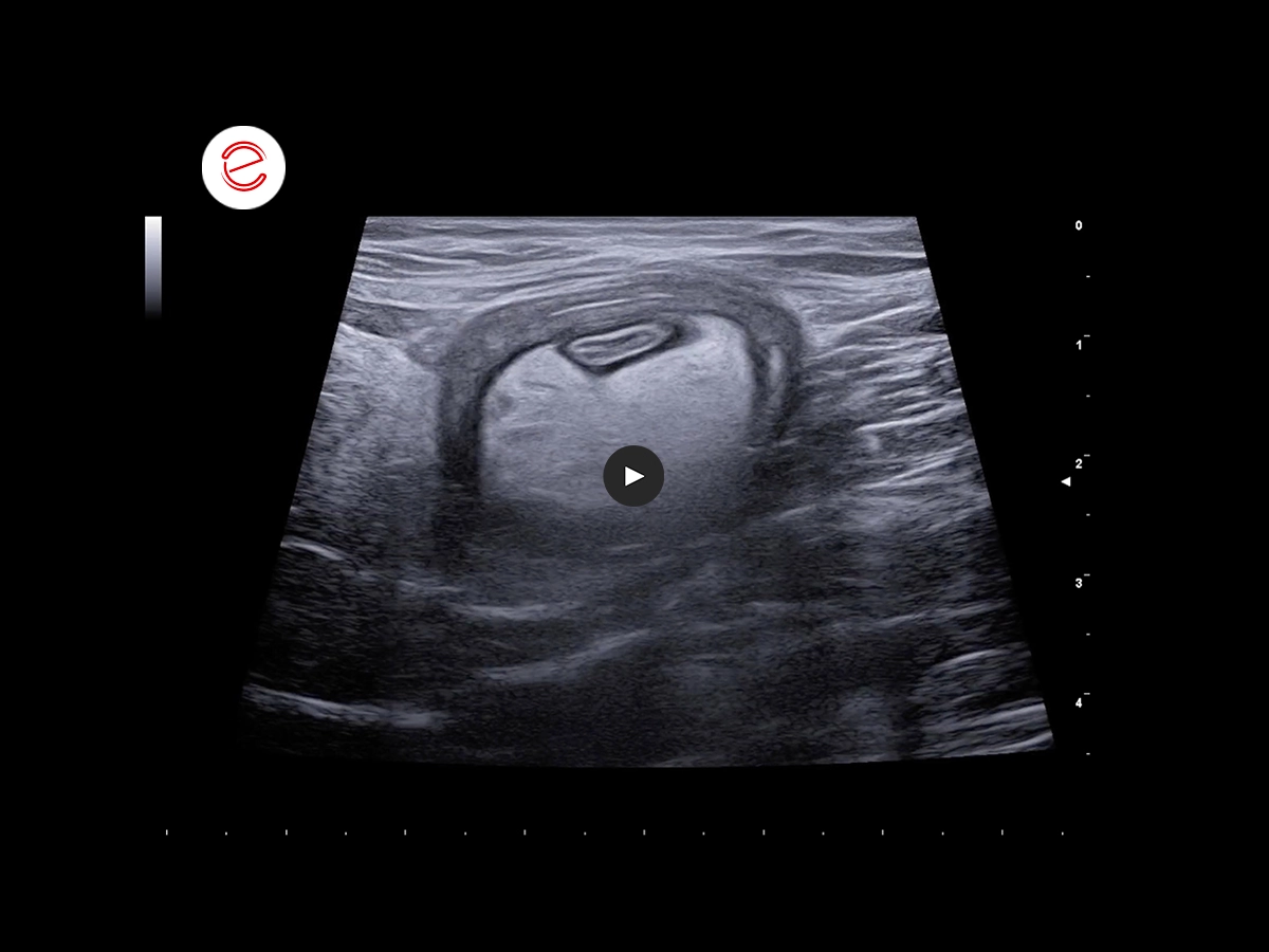 Concentric structure is apparent, where the outer wall probably part of the colon, while the inner wall consists of small intestine