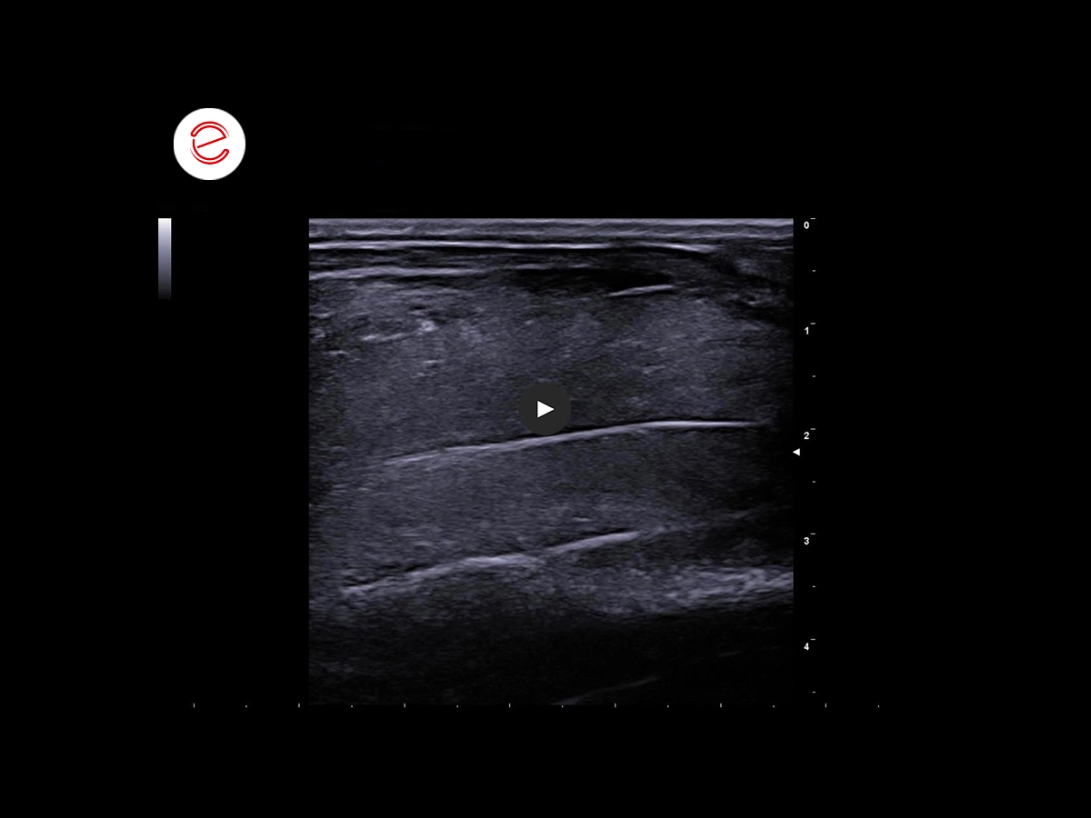 Brachial biceps rupture 2