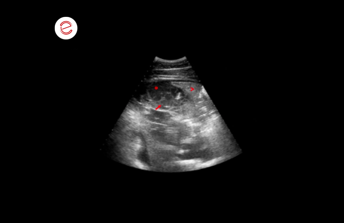 Pharyngeal lymphoid hyperplasia and a significant presence of mucopurulent exudate in the tracheal lumen