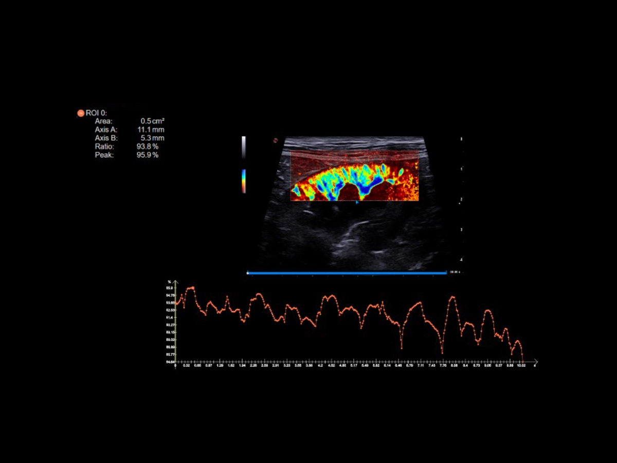 micro vascularization imaging, MicroV