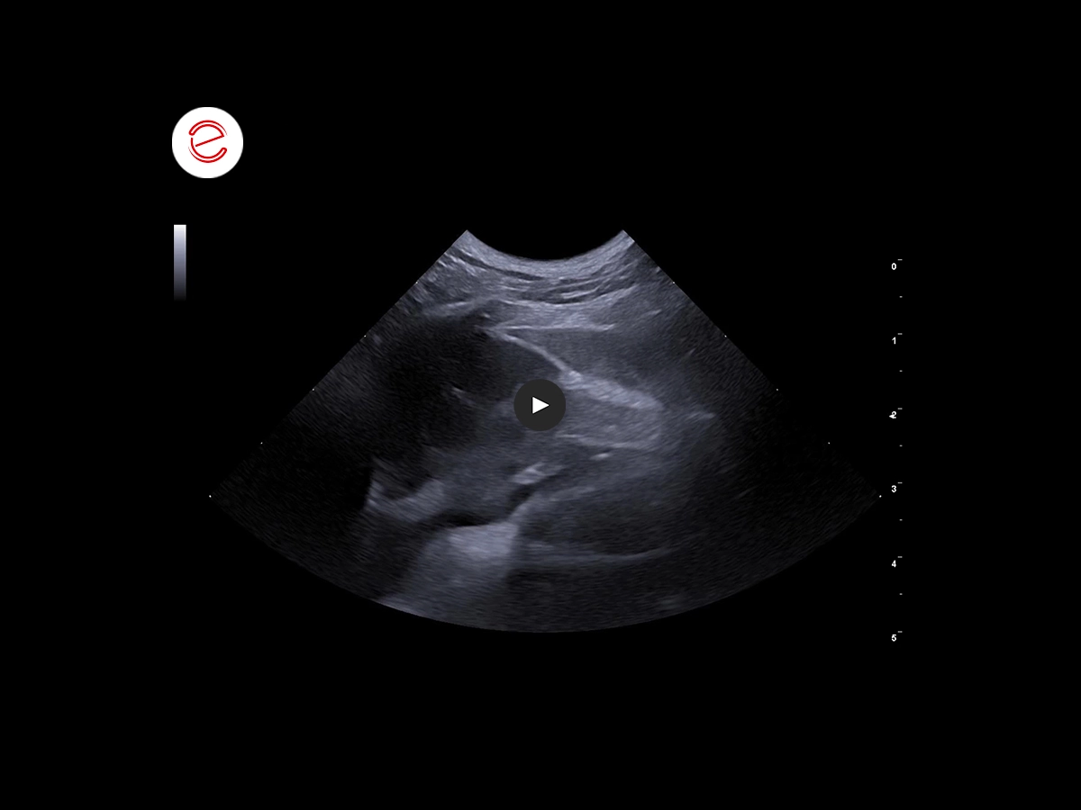 Right atrial Hemangiosarcoma 4