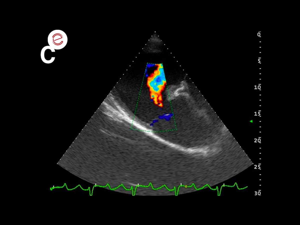 Mild pulmonary regurgitation jet